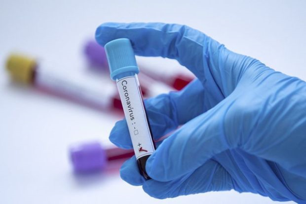 Azərbaycanda daha 77 nəfərdə koronavirus aşkarlandı - RƏSMİ
